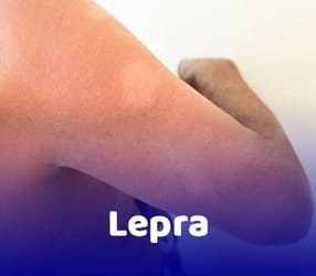 Lepra